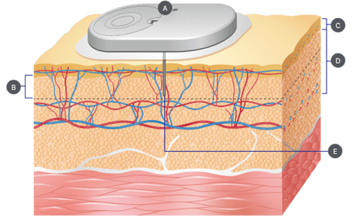How does a Continuous Glucose Monitoring System work?